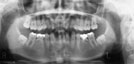 歯数異常のレントゲン写真